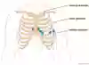 Bild som visar bröstavledningar vid EKG
