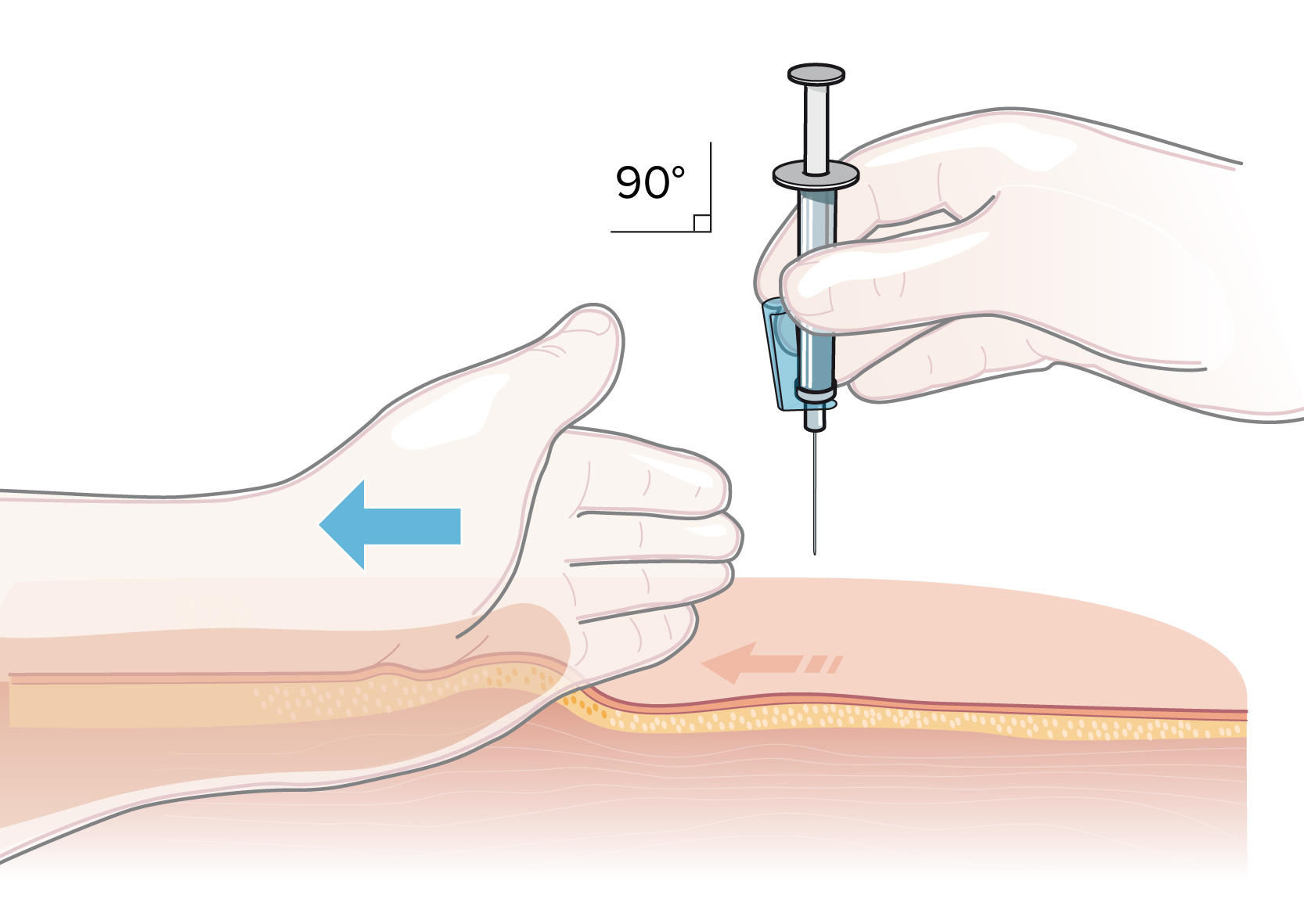 intramuskulär injektion i genomskärning där hud och subkutan vävnad förskjuts med ena handen
