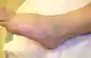 Bild som visar att huden på foten är tjock och gråfärgad