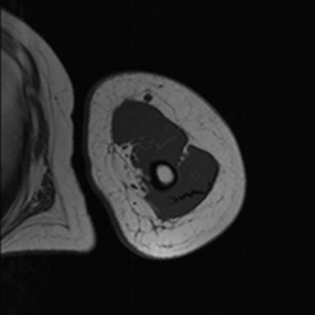 Bild som visar MRT överarm med lymfödem