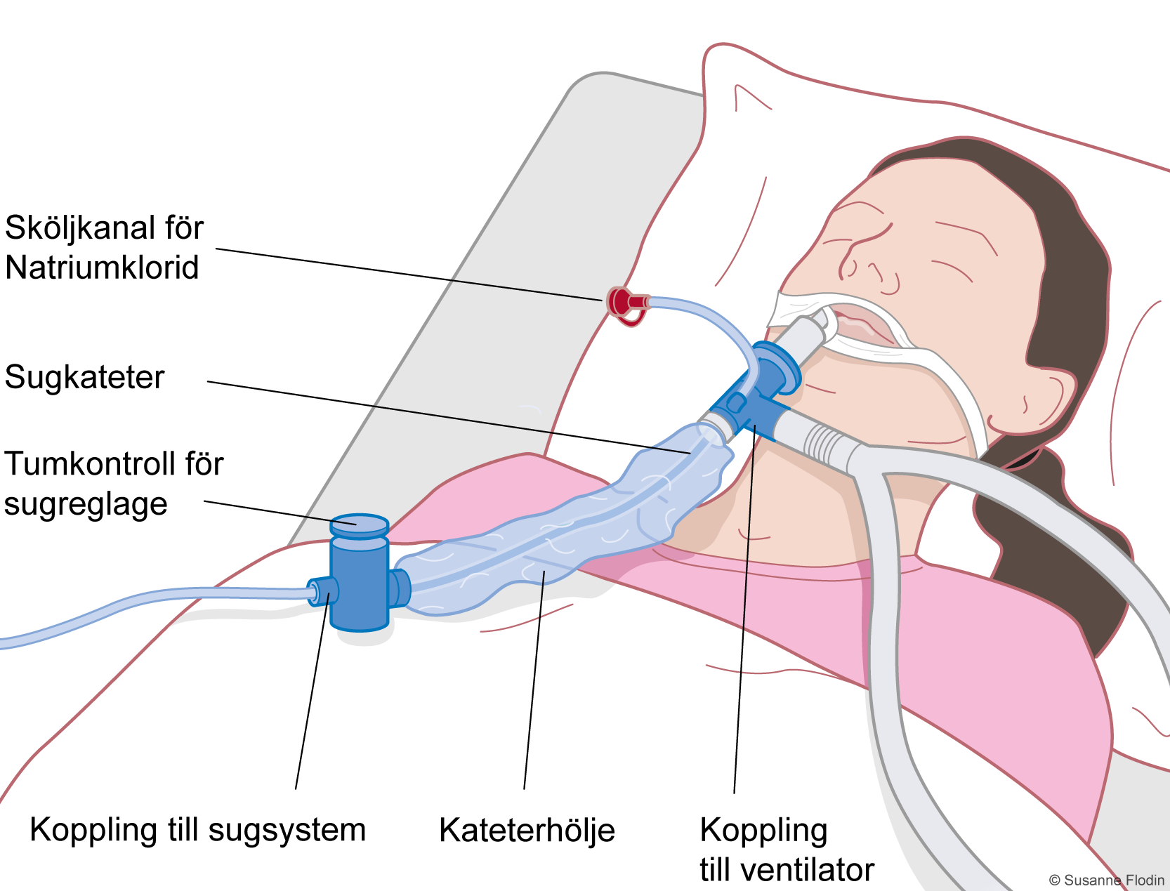 Patient ansluten till ventilator med slutet sugsystem.
