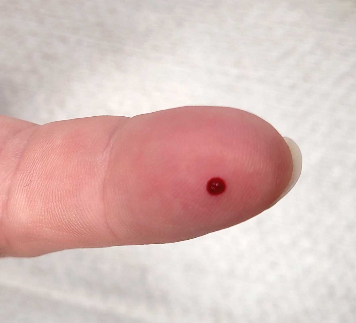 Bild som visar korrekt provtagningsställe på finger i samband med kapillär provtagning