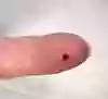 Bild som visar korrekt provtagningsställe på finger i samband med kapillär provtagning