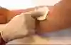 Bild som visar blododling huddesinfektion