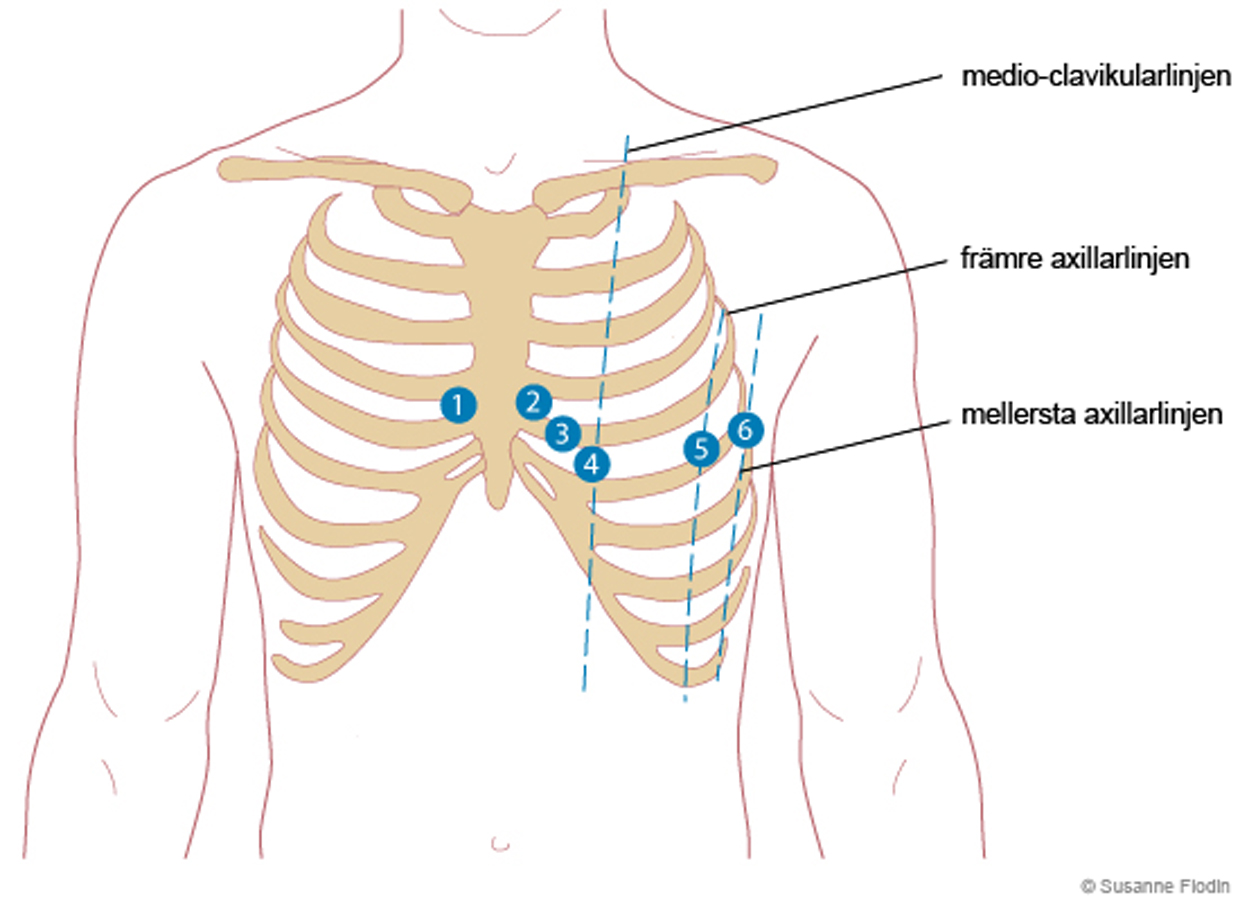 Bild som visar bröstavledningar vid EKG