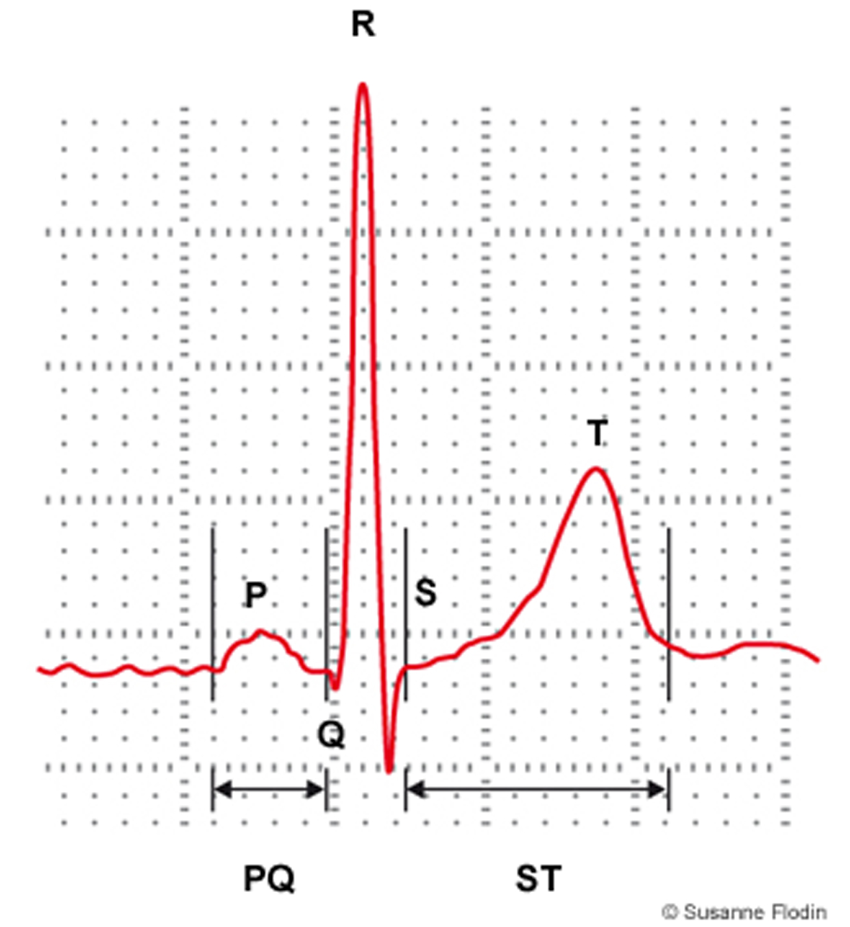 Bild som visar ett EKG-komplex