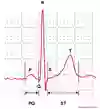 Bild som visar ett EKG-komplex