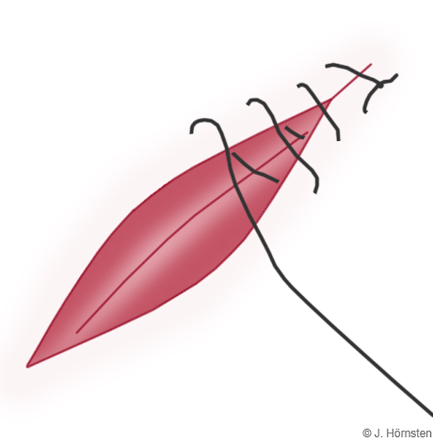 Bild som visar fortlöpande genomgripande sutur. 