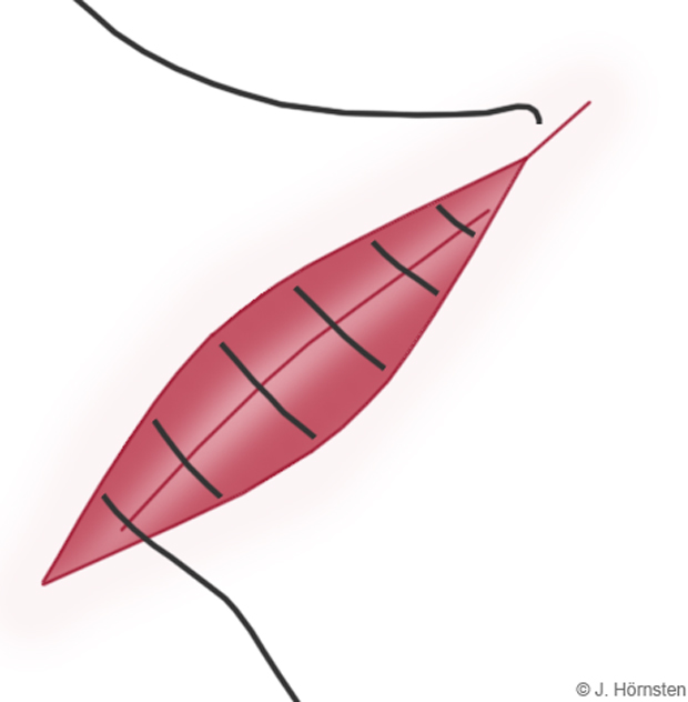Bild som visar fortlöpande sutur. 