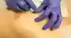Bild som visar hur man sticker portnålen genom huden