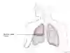 Thoraxdränage vid pneumothorax.