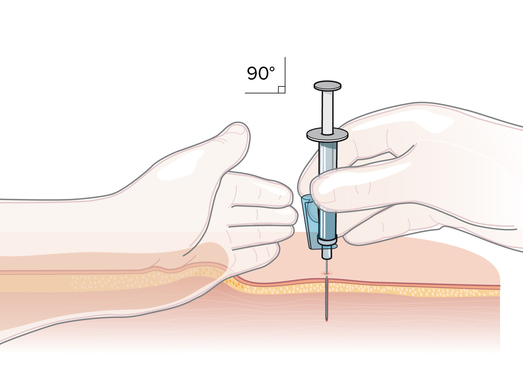 Intramuskulär injektion i genomskärning där kanylen sticks in i 90 grader