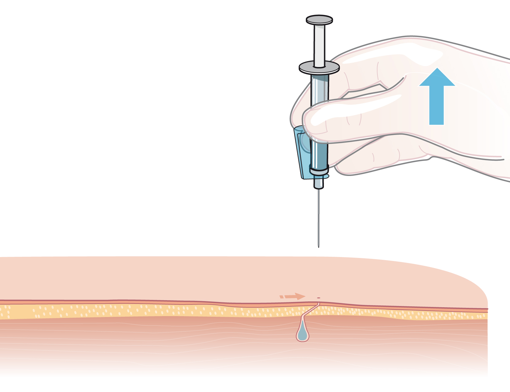 Intramuskulär injektion i genomskärning där kanylen dras ut och en avbruten stickkanal visas