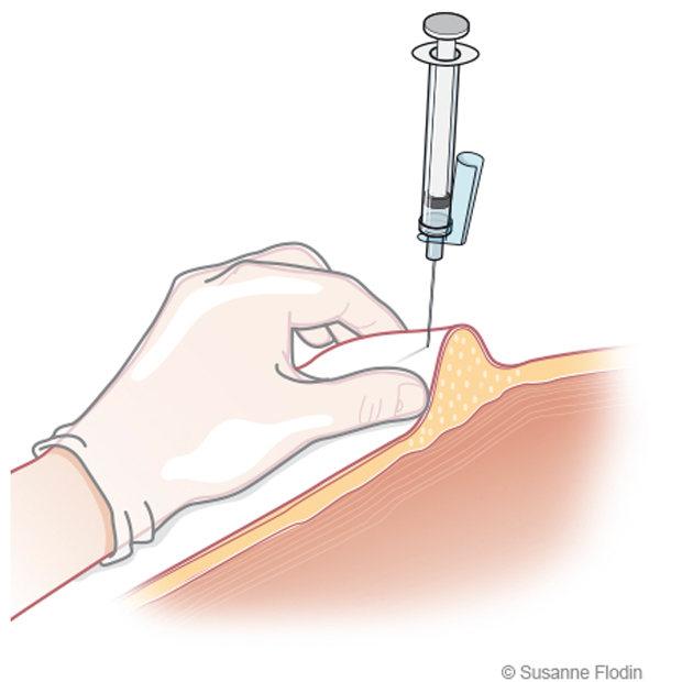 Bild som visar subkutan injektion