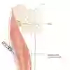 Illustration av lårets utsida med den yttre breda lårmuskeln (vastus lateralis) markerad. Det rekommenderade området för intramuskulär injektion visas som ett avgränsat fält mitt på muskeln, mellan höft och knä.