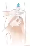 Illustration av sätesregionen med den dorsogluteala injektionsplatsen markerad i den yttre övre kvadranten av sätet.