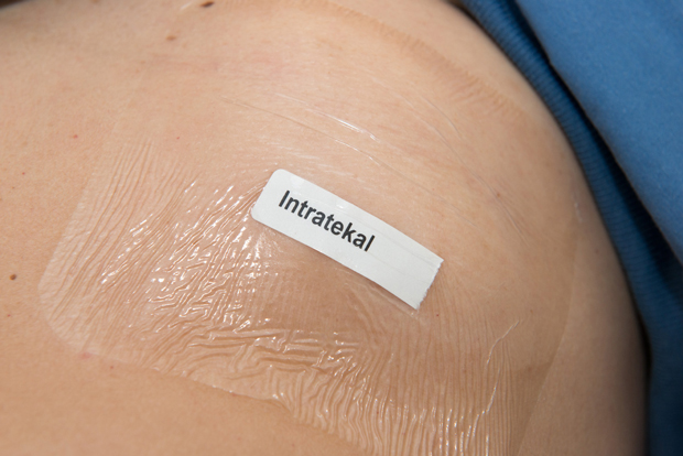 Bild som visar märkning med etikett på huden över platsen för den intratekala porten.