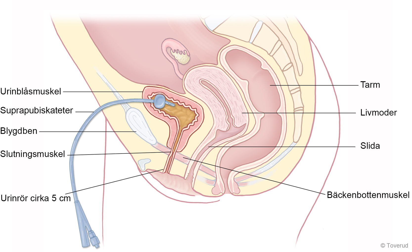 Bild som visar suprapubisk kateterisering av kvinna