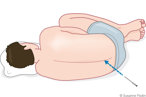 Bild som visar liggande patient vid lumbalpunktion