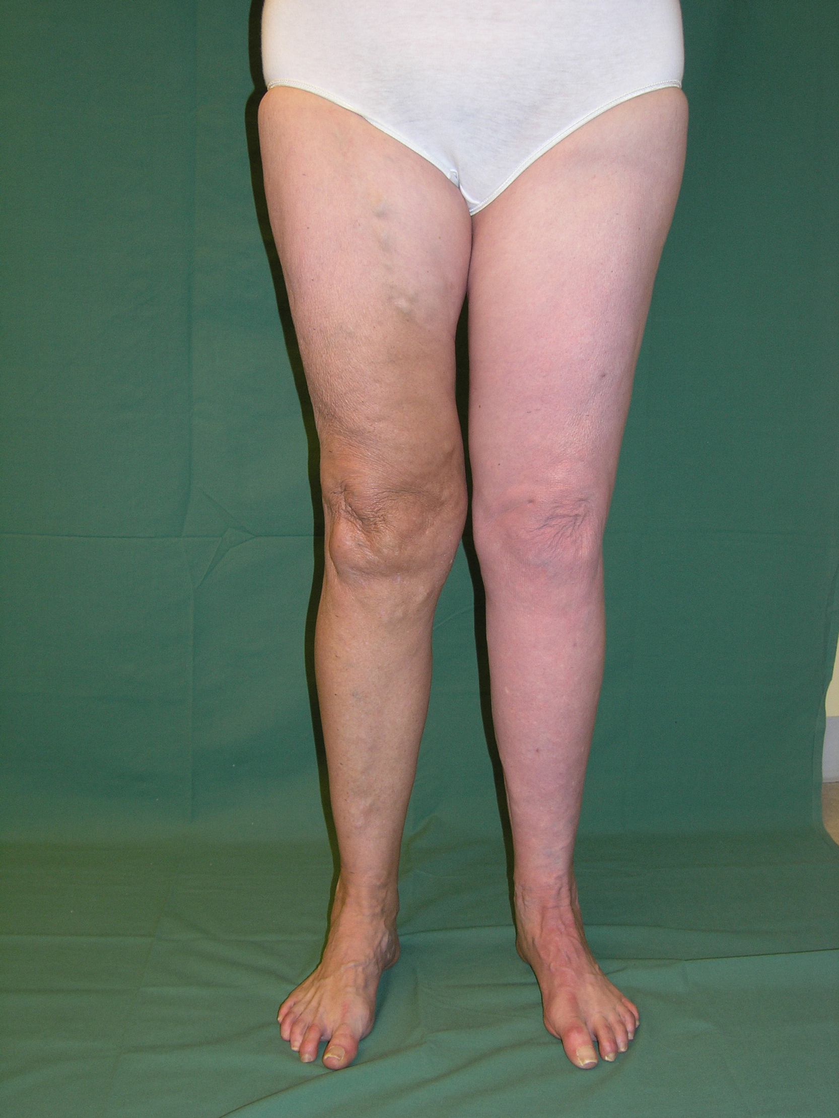 Bild som visar ben 6 månader efter operation