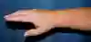 Bild som visar arm efter intensivbehandling