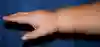 Bild som visar arm före intensivbehandling