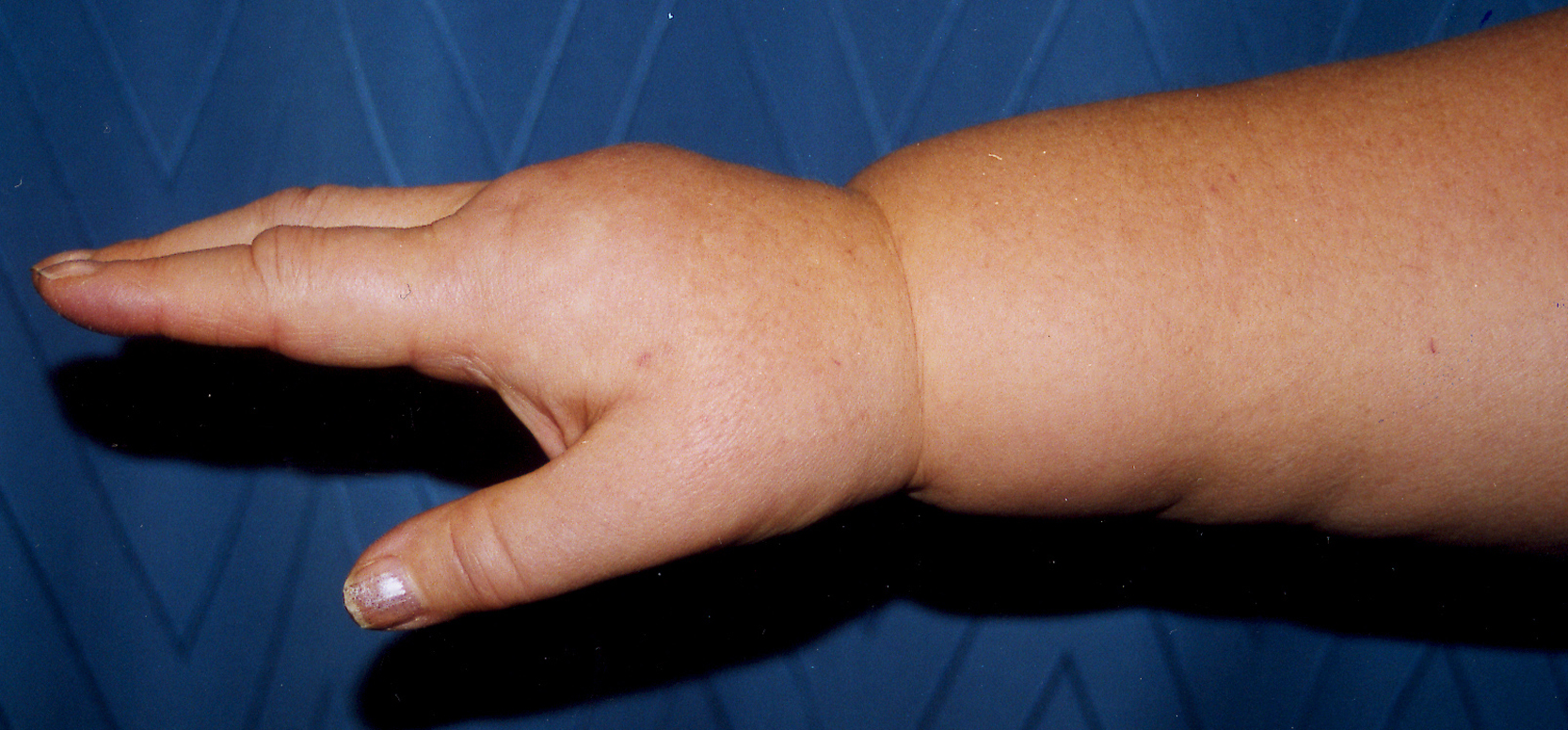 Bild som visar arm före intensivbehandling