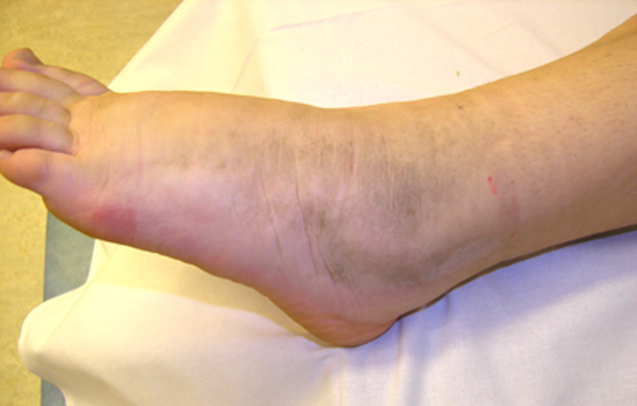 Bild som visar att huden på foten är tjock och gråfärgad