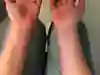 Bild som visar mindre synliga vener på underarmens insida vid armödem