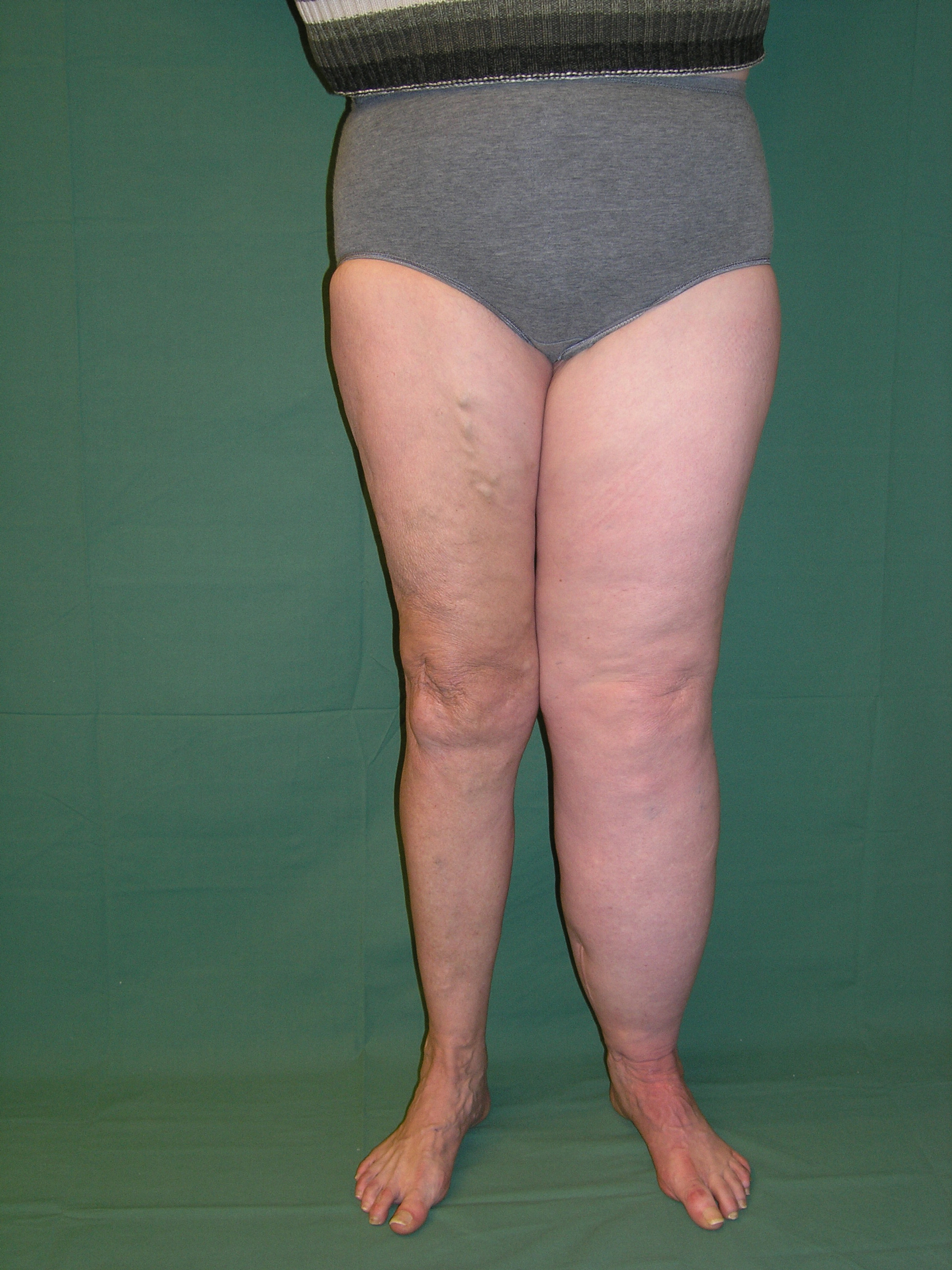 Bild som visar vänster ben innan fettsugning