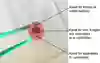 Hematurikateter i genomskärning synliggör kateterns tre parallella kanaler för fyllning av kateterballong, utflöde urin och spolvätska samt inflöde spolvätska
