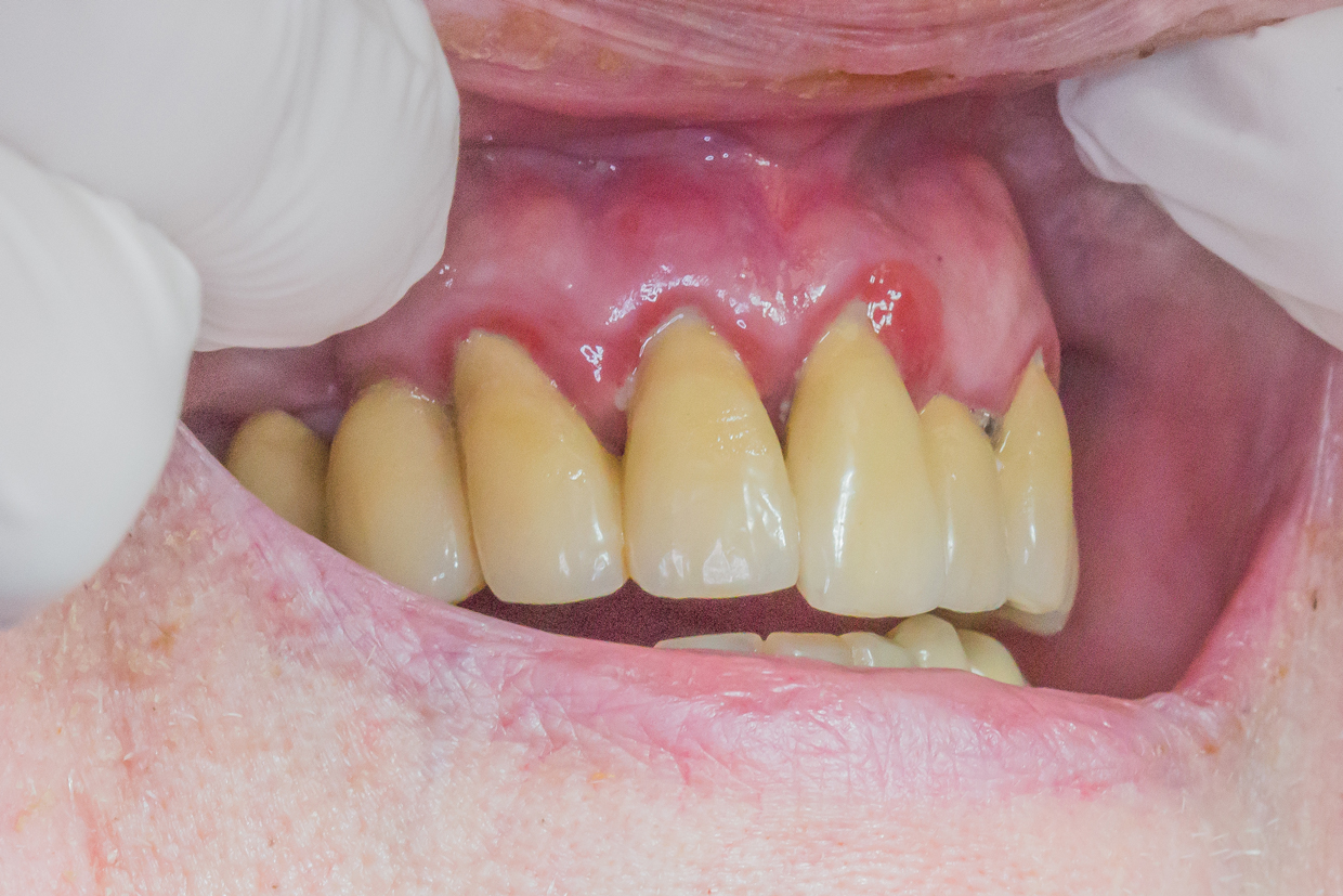 Bild som visar tandköttsinflmmation