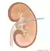 Bild som visar nefrostomins placering i njuren