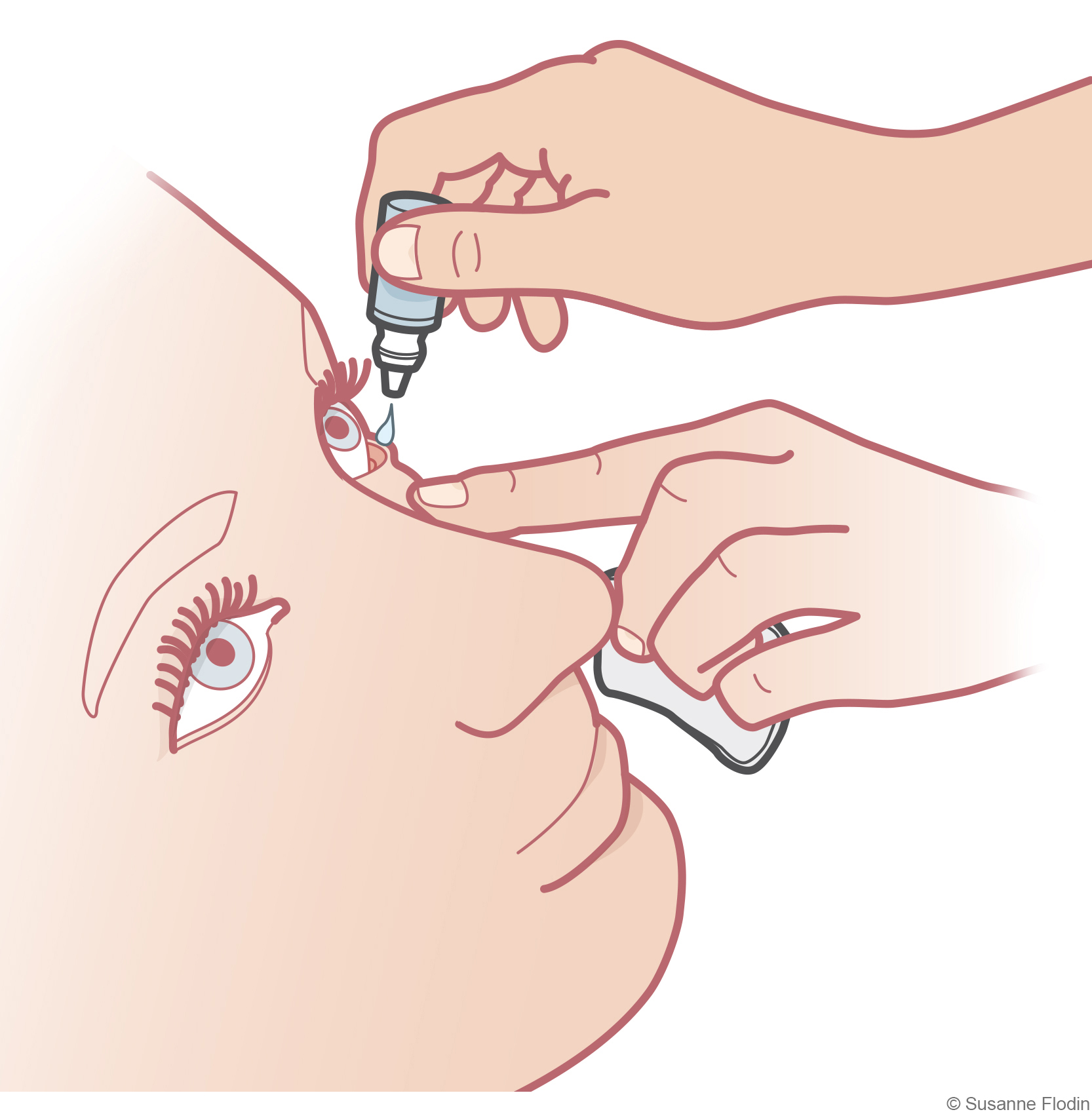 Bild som visar applicering av ögondroppar i ögat.