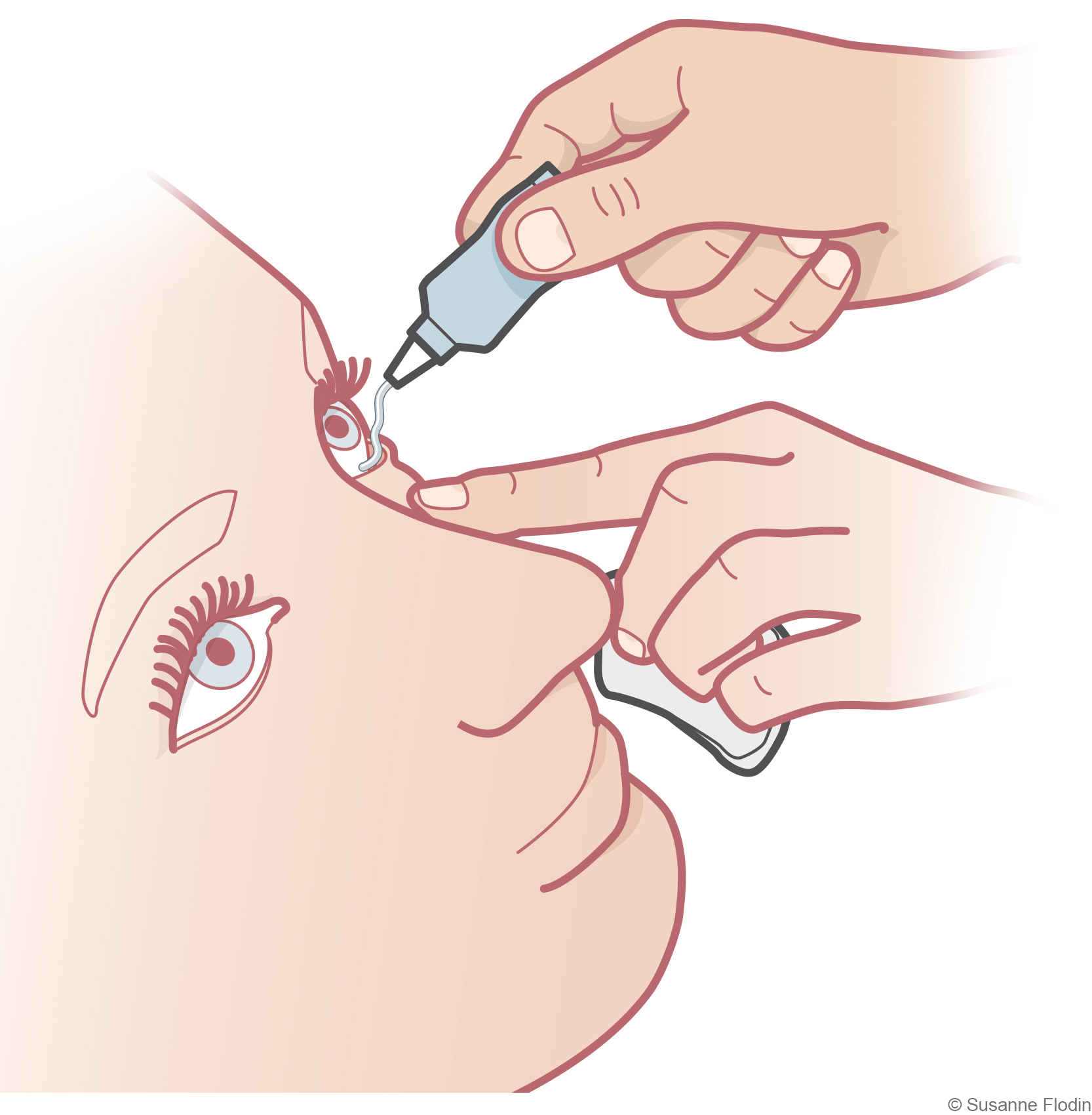 Bild som visar applicering av ögonsalva i ögat. 