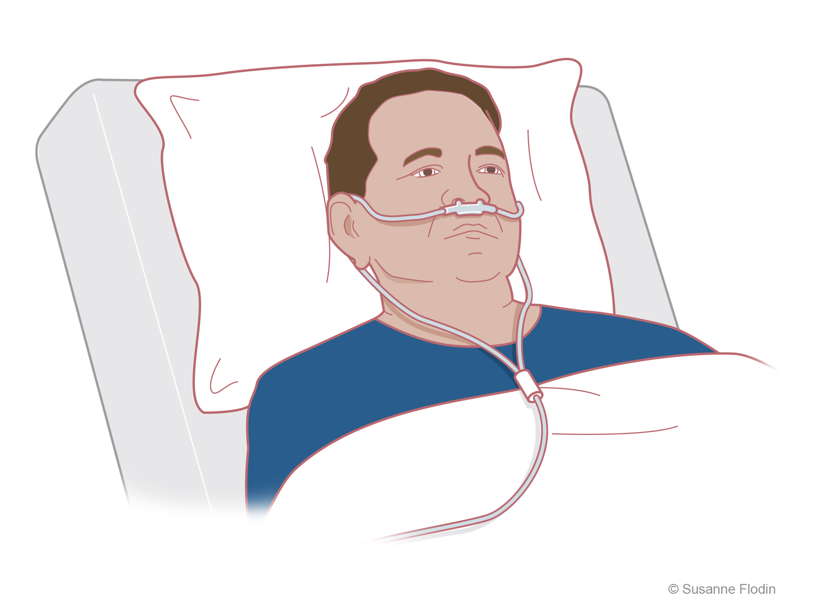 Bild som visar näsgrimma vid oxygenbehandling