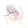 Anatomisk bild peritonealdialys