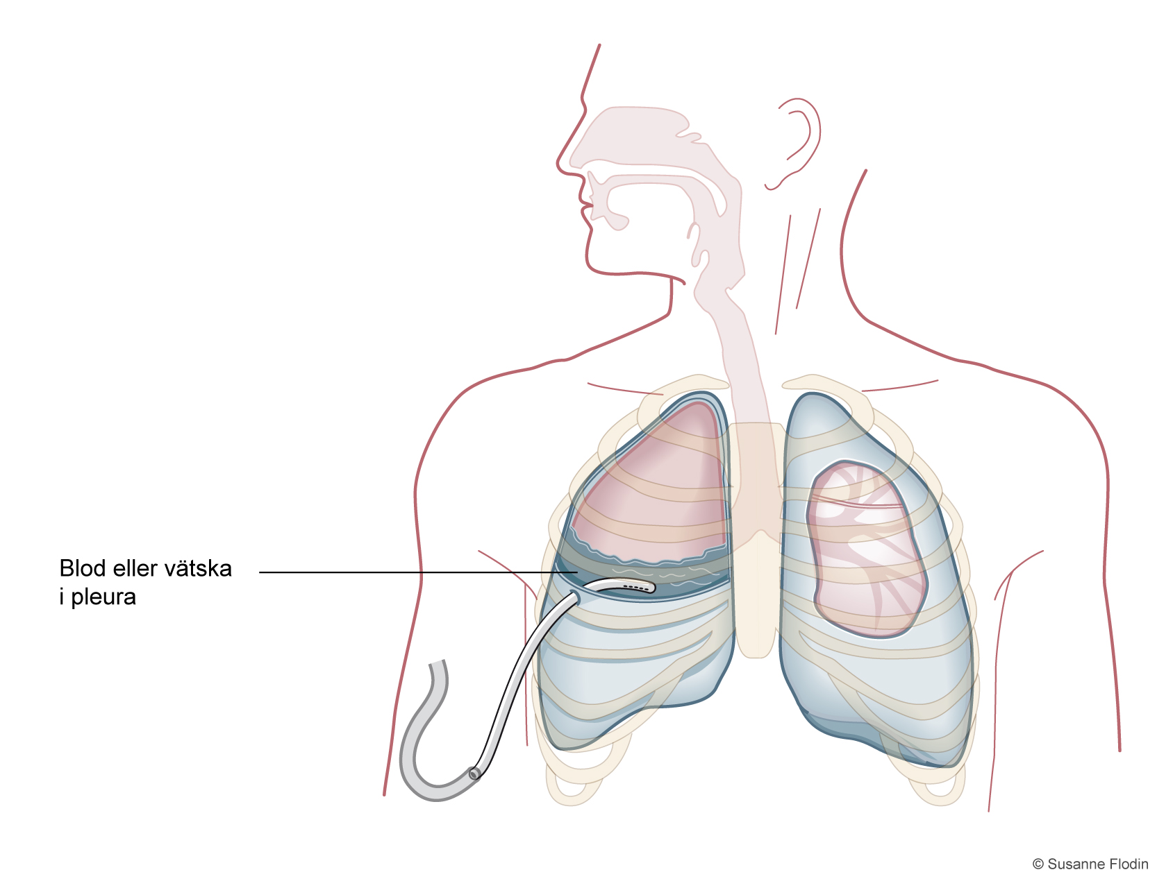 Thoraxdränage vid hemothorax i genomskärning där de olika delarna namnges samt dränageplacering.