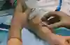 Bild som visar en ultraljudsprob  på hud och en PVK som är på väg att sättas i kärl