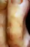 Bild som visar skabbgång i hudens hornlager på tå