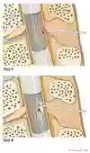 Bilderna visar placering av kateterspetsen vid epidural respektive intratekal smärtbehandling