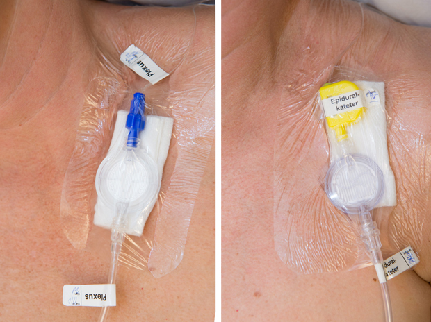 Bild till vänster visar exempel på märkning av perifer smärtbehandlingskateter i ett nervplexus.  Den högra bilden visar exempel på märkning av epidural smärtbehandlingskateter.