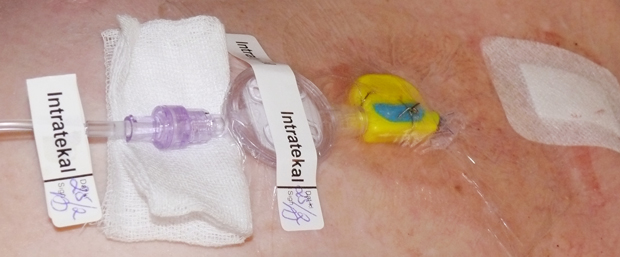 Bild som visar exempel på märkning av intratekal kateter