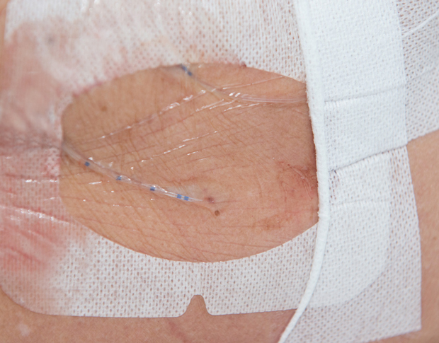Bild som visar hur katetern mynnar ut genom huden.