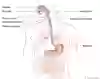 Bild som visar inlagd dräneringssond