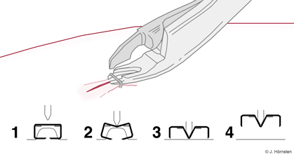 Bild som visar borttagning av staples