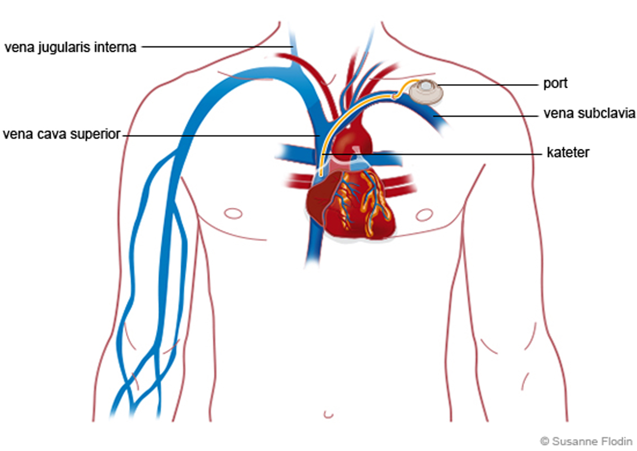 Anatomisk bild som visar subkutan venport