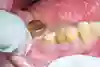 Bild som visar en guldkrona och en tand som förlorat sin krona