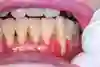 Bild som visar tandlossning med inflammerat tandkött och bennedbrytning av käkbenet