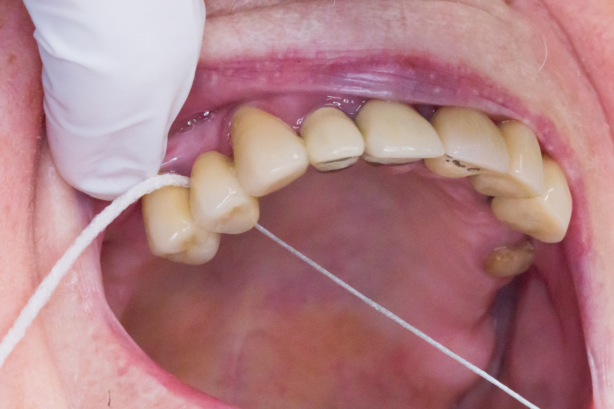 Bild som visar hur tandtråd används